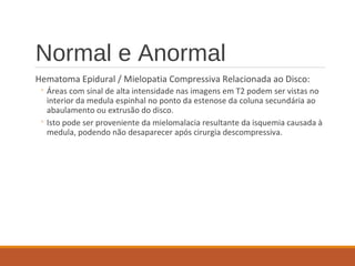 Normal e Anormal
Hematoma Epidural / Mielopatia Compressiva Relacionada ao Disco:
◦ Áreas com sinal de alta intensidade nas imagens em T2 podem ser vistas no
interior da medula espinhal no ponto da estenose da coluna secundária ao
abaulamento ou extrusão do disco.
◦ Isto pode ser proveniente da mielomalacia resultante da isquemia causada à
medula, podendo não desaparecer após cirurgia descompressiva.
 
