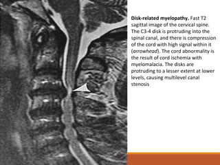 Disk-related myelopathy. Fast T2
sagittal image of the cervical spine.
The C3-4 disk is protruding into the
spinal canal, and there is compression
of the cord with high signal within it
(arrowhead). The cord abnormality is
the result of cord ischemia with
myelomalacia. The disks are
protruding to a lesser extent at lower
levels, causing multilevel canal
stenosis
 