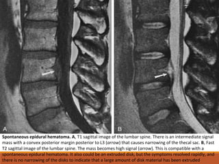 Spontaneous epidural hematoma. A, T1 sagittal image of the lumbar spine. There is an intermediate signal
mass with a convex posterior margin posterior to L3 (arrow) that causes narrowing of the thecal sac. B, Fast
T2 sagittal image of the lumbar spine. The mass becomes high signal (arrow). This is compatible with a
spontaneous epidural hematoma. It also could be an extruded disk, but the symptoms resolved rapidly, and
there is no narrowing of the disks to indicate that a large amount of disk material has been extruded
 