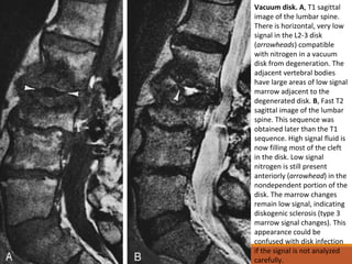Vacuum disk. A, T1 sagittal
image of the lumbar spine.
There is horizontal, very low
signal in the L2-3 disk
(arrowheads) compatible
with nitrogen in a vacuum
disk from degeneration. The
adjacent vertebral bodies
have large areas of low signal
marrow adjacent to the
degenerated disk. B, Fast T2
sagittal image of the lumbar
spine. This sequence was
obtained later than the T1
sequence. High signal fluid is
now filling most of the cleft
in the disk. Low signal
nitrogen is still present
anteriorly (arrowhead) in the
nondependent portion of the
disk. The marrow changes
remain low signal, indicating
diskogenic sclerosis (type 3
marrow signal changes). This
appearance could be
confused with disk infection
if the signal is not analyzed
carefully.
 
