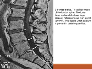 Calcified disks. T1 sagittal image
of the lumbar spine. The lower
three lumbar disks have large
areas of heterogeneous high signal
(arrows). This occurs when calcium
is present in certain quantities.
 