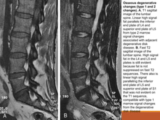 Osseous degenerative
changes (type 1 and 2
changes). A, T1 sagittal
image of the lumbar
spine. Linear high signal
fat parallels the inferior
end plate of L4 and
superior end plate of L5
from type 2 marrow
signal changes
associated with adjacent
degenerative disk
disease. B, Fast T2
sagittal image of the
lumbar spine. High signal
fat in the L4 and L5 end
plates is still evident
because fat is not
suppressed on fast T2
sequences. There also is
linear high signal
paralleling the inferior
end plate of L5 and
superior end plate of S1
that was not evident on
the T1 sequence,
compatible with type 1
marrow signal changes
from the degenerative
disk disease
 