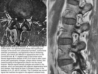 Degenerative facet joint disease. A, T1 axial image of the
lumbar spine. The right facet joint shows mild hypertrophic
changes of the bones from osteophyte formation, subchondral
sclerosis (arrowheads), and ligamentum flavum thickening
(arrow), all of which are different in appearance than on the
normal left side. B, T1 sagittal image of the lumbar spine.
Severe degenerative disease of the L5-S1 facet is seen (open
arrow) with hypertrophic changes, a large inferior recess, and
inward buckling of the ligamentum flavum into the neural
foramen. Marrow signal intensity changes are evident in the
pedicles, which are associated with adjacent degenerative facet
joint disease. High signal fat (type 2 changes) is seen in the
pedicles of L4, L5, and S1 (arrows). The L3 pedicle has normal
signal that matches the signal in the adjacent vertebral body.
 