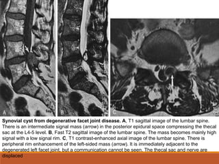 Synovial cyst from degenerative facet joint disease. A, T1 sagittal image of the lumbar spine.
There is an intermediate signal mass (arrow) in the posterior epidural space compressing the thecal
sac at the L4-5 level. B, Fast T2 sagittal image of the lumbar spine. The mass becomes mainly high
signal with a low signal rim. C, T1 contrast-enhanced axial image of the lumbar spine. There is
peripheral rim enhancement of the left-sided mass (arrow). It is immediately adjacent to the
degenerated left facet joint, but a communication cannot be seen. The thecal sac and nerve are
displaced
 