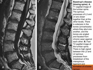 Baastrup's disease
(kissing spine). A,
T1 sagittal image of
the lumbar spine.
The spinous
processes of L3 and
L4 are closer
together than at the
other levels. There
is sclerosis in the
bones (arrowheads)
where they abut one
another, and the
bones are angled
and faceted from
chronic wear against
each other. B, Fast
T2 sagittal image of
the lumbar spine.
There is high signal
between the L3 and
L4 spinous
processes from
breakdown of the
interspinous
ligament and
formation of a bursa
(arrow).
 