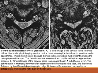 Central canal stenosis: cervical (acquired). A, T2*
axial image of the cervical spine. There is
diffuse disko-osteophytic bulging into the central canal, causing the thecal sac to lose its rounded
appearance. This is mild in extent because there is still cerebrospinal fluid present between the
osteophyte and the cord. The neural foramina are normal and unaffected by the degenerative
process. B, T2*
axial image of the cervical spine (same patient as in A but different level). The
central canal is markedly narrowed with essentially no cerebrospinal fluid seen, and the cord is
flattened by the diffuse disko-osteophytic bulge. Both neural foramina are narrowed from
osteophytes, worse on the right than on the left side
 