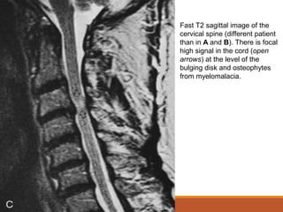 Fast T2 sagittal image of the
cervical spine (different patient
than in A and B). There is focal
high signal in the cord (open
arrows) at the level of the
bulging disk and osteophytes
from myelomalacia.
 