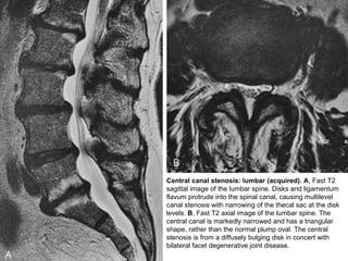 Central canal stenosis: lumbar (acquired). A, Fast T2
sagittal image of the lumbar spine. Disks and ligamentum
flavum protrude into the spinal canal, causing multilevel
canal stenosis with narrowing of the thecal sac at the disk
levels. B, Fast T2 axial image of the lumbar spine. The
central canal is markedly narrowed and has a triangular
shape, rather than the normal plump oval. The central
stenosis is from a diffusely bulging disk in concert with
bilateral facet degenerative joint disease.
 