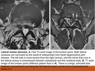 Lateral recess stenosis. A, Fast T2 axial image of the lumbar spine. Both lateral
recesses are narrowed as the result of osteophytes from facet degenerative joint
disease. The left side is more severe than the right (arrow), and the nerve that runs in
the lateral recess is compressed between osteophyte and the vertebral body. B, T1 axial
image of the lumbar spine (different patient than in A). There is a large, extruded disk
fragment (arrowhead) narrowing the left lateral recess (arrow) and compressing the
nerve in it.
 