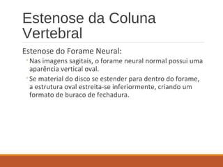 Estenose da Coluna
Vertebral
Estenose do Forame Neural:
◦Nas imagens sagitais, o forame neural normal possui uma
aparência vertical oval.
◦Se material do disco se estender para dentro do forame,
a estrutura oval estreita-se inferiormente, criando um
formato de buraco de fechadura.
 