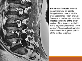 Foraminal stenosis. Normal
neural foramina on sagittal
images should have a vertical
oval appearance (open arrows).
Stenosis from disk abnormalities
creates narrowing of the lower
portion of the foramen so that it
has a keyhole appearance (solid
arrows). The dorsal root ganglion
is evident in the superior portion
of the lumbar foramina.
 