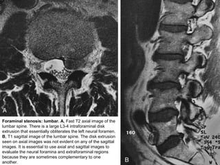 Foraminal stenosis: lumbar. A, Fast T2 axial image of the
lumbar spine. There is a large L3-4 intraforaminal disk
extrusion that essentially obliterates the left neural foramen.
B, T1 sagittal image of the lumbar spine. The disk extrusion
seen on axial images was not evident on any of the sagittal
images. It is essential to use axial and sagittal images to
evaluate the neural foramina and extraforaminal regions
because they are sometimes complementary to one
another.
 