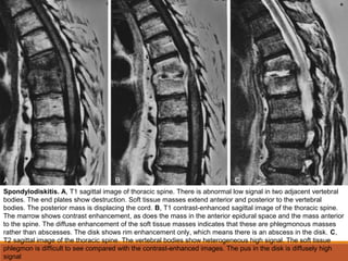 Spondylodiskitis. A, T1 sagittal image of thoracic spine. There is abnormal low signal in two adjacent vertebral
bodies. The end plates show destruction. Soft tissue masses extend anterior and posterior to the vertebral
bodies. The posterior mass is displacing the cord. B, T1 contrast-enhanced sagittal image of the thoracic spine.
The marrow shows contrast enhancement, as does the mass in the anterior epidural space and the mass anterior
to the spine. The diffuse enhancement of the soft tissue masses indicates that these are phlegmonous masses
rather than abscesses. The disk shows rim enhancement only, which means there is an abscess in the disk. C,
T2 sagittal image of the thoracic spine. The vertebral bodies show heterogeneous high signal. The soft tissue
phlegmon is difficult to see compared with the contrast-enhanced images. The pus in the disk is diffusely high
signal
 