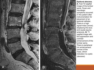 Epidural abscess.
A, Fast T2 sagittal
image of the lumbar
spine. Fever and
neurologic
symptoms occurred
in this patient after
instrumentation for
placement of an
epidural catheter.
There is a high
signal mass (arrow)
displacing the dura
and cauda equina
anteriorly. B, T1
sagittal image with
fat suppression and
contrast
enhancement of the
lumbar spine.
There is peripheral
rim enhancement
(arrow) of the
mass, which
indicates it is cystic
(abscess).
 