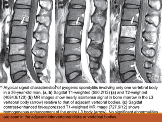 Atypical signal characteristics of pyogenic spondylitis involving only one vertebral body
in a 36-year-old man. (a, b) Sagittal T1-weighted (550.2/12) (a) and T2-weighted
(4084.9/120) (b) MR images show nearly isointense signal in bone marrow in the L3
vertebral body (arrow) relative to that of adjacent vertebral bodies. (c) Sagittal
contrast-enhanced fat-suppressed T1-weighted MR image (727.9/12) shows
homogeneous enhancement of the entire L3 body (arrow). No significant abnormalities
are seen in the adjacent intervertebral disks or vertebral bodies.
 