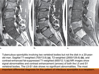 Tuberculous spondylitis involving two vertebral bodies but not the disk in a 20-year-
old man. Sagittal T1-weighted (700/13.8) (a), T2-weighted (2850/129.6) (b), and
contrast-enhanced fat-suppressed T1-weighted (600/12.1) (c) MR images show
signal abnormalities and contrast enhancement (arrows) of both the L5 and S1
vertebral bodies. The L5-S1 disk shows no significant abnormalities. The most
important differential diagnosis for this pattern of infectious spondylitis is a neoplasm.
 