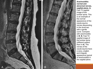 Arachnoiditis:
normal and
abnormal nerves,
sagittal plane. A,
Fast T2 sagittal
image of the
lumbar spine. This
is an example of
the normal
appearance of the
cauda equina
nerves descending
in the dural sac
with a gentle
curve. Compare
with arachnoiditis
in B. B, Fast T2
sagittal image of
the lumbar spine
(different patient
than in A). The
nerves of the
cauda equina have
a wavy, angled,
and irregular
appearance typical
of arachnoiditis in
the sagittal plane.
 