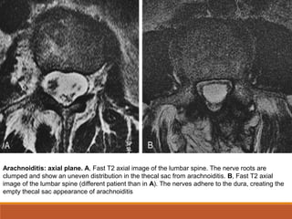 Arachnoiditis: axial plane. A, Fast T2 axial image of the lumbar spine. The nerve roots are
clumped and show an uneven distribution in the thecal sac from arachnoiditis. B, Fast T2 axial
image of the lumbar spine (different patient than in A). The nerves adhere to the dura, creating the
empty thecal sac appearance of arachnoiditis
 