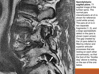 Spondylolysis:
sagittal plane. T1
sagittal image of the
lumbar spine. The
normal pars
interarticularis at L5 is
shown for reference
(solid white arrow).
The pars at L4 is in
two separate
fragments (1, 2), and
a large spondylolytic
defect in the pars is
shown (open arrow).
The gap created by
the L4 pars defect is
filled by inferior and
superior articular
processes that are
resting on each other
(arrowheads), so that
the foot of the “Scottie
dog” above is resting
on the ear of the one
below.
 