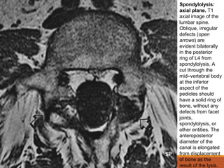 Spondylolysis:
axial plane. T1
axial image of the
lumbar spine.
Oblique, irregular
defects (open
arrows) are
evident bilaterally
in the posterior
ring of L4 from
spondylolysis. A
cut through the
mid–vertebral body
at the inferior
aspect of the
pedicles should
have a solid ring of
bone, without any
defects from facet
joints,
spondylolysis, or
other entities. The
anteroposterior
diameter of the
canal is elongated
from displacement
of bone as the
result of the lysis.
 