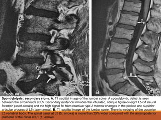 Spondylolysis: secondary signs. A, T1 sagittal image of the lumbar spine. A spondylolytic defect is seen
between the arrowheads at L5. Secondary evidence includes the lobulated, oblique figure-of-eight L5-S1 neural
foramen (solid arrows) and the high signal fat from reactive type 2 marrow changes in the pedicle and superior
articular process of L5 (open arrow). B, T1 sagittal image of the lumbar spine. There is wedging of the posterior
L5 vertebral body. The spinal canal at L5 (5; arrows) is more than 25% wider compared with the anteroposterior
diameter of the canal at L1 (1; arrows
 