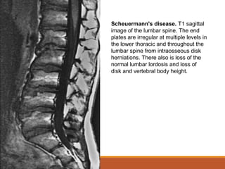 Scheuermann's disease. T1 sagittal
image of the lumbar spine. The end
plates are irregular at multiple levels in
the lower thoracic and throughout the
lumbar spine from intraosseous disk
herniations. There also is loss of the
normal lumbar lordosis and loss of
disk and vertebral body height.
 