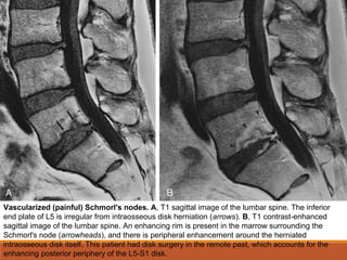 Vascularized (painful) Schmorl's nodes. A, T1 sagittal image of the lumbar spine. The inferior
end plate of L5 is irregular from intraosseous disk herniation (arrows). B, T1 contrast-enhanced
sagittal image of the lumbar spine. An enhancing rim is present in the marrow surrounding the
Schmorl's node (arrowheads), and there is peripheral enhancement around the herniated
intraosseous disk itself. This patient had disk surgery in the remote past, which accounts for the
enhancing posterior periphery of the L5-S1 disk.
 