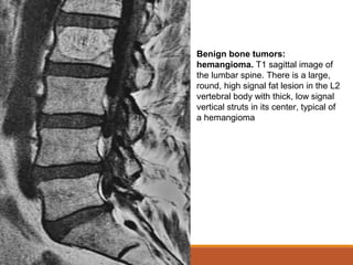 Benign bone tumors:
hemangioma. T1 sagittal image of
the lumbar spine. There is a large,
round, high signal fat lesion in the L2
vertebral body with thick, low signal
vertical struts in its center, typical of
a hemangioma
 