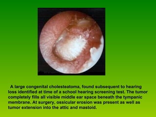    A large congenital cholesteatoma, found subsequent to hearing loss identified at time of a school hearing screening test. The tumor completely fills all visible middle ear space beneath the tympanic membrane. At surgery, ossicular erosion was present as well as tumor extension into the attic and mastoid.  
