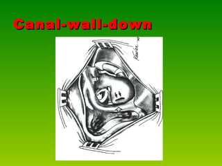 Canal-wall-down  