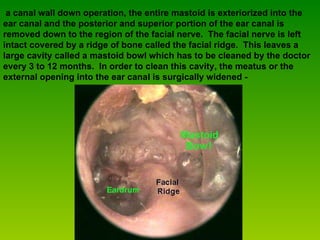 a canal wall down operation, the entire mastoid is exteriorized into the ear canal and the posterior and superior portion of the ear canal is removed down to the region of the facial nerve.  The facial nerve is left intact covered by a ridge of bone called the facial ridge.  This leaves a large cavity called a mastoid bowl which has to be cleaned by the doctor every 3 to 12 months.  In order to clean this cavity, the meatus or the external opening into the ear canal is surgically widened -   