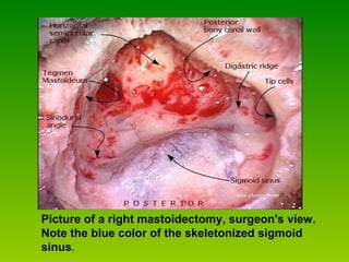 Picture of a left mastoidectomy, surgeon's view. Picture of a right mastoidectomy, surgeon's view.  Note the blue color of the skeletonized sigmoid sinus . 