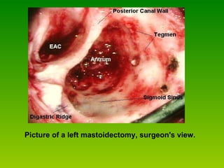 Picture of a left mastoidectomy, surgeon's view. 