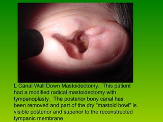 L Canal Wall Down Mastoidectomy.  This patient had a modified radical mastoidectomy with tympanoplasty.  The posterior bony canal has been removed and part of the dry "mastoid bowl" is visible posterior and superior to the reconstructed tympanic membrane  