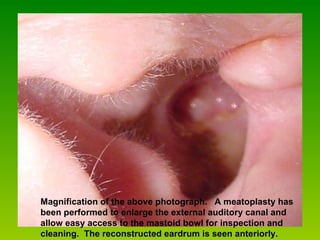 Magnification of the above photograph.   A meatoplasty has been performed to enlarge the external auditory canal and allow easy access to the mastoid bowl for inspection and cleaning.  The reconstructed eardrum is seen anteriorly.  