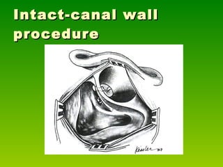 Intact-canal wall procedure 