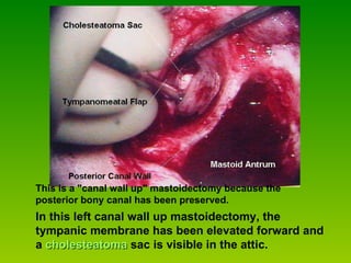 In this left canal wall up mastoidectomy, the tympanic membrane has been elevated forward and a  cholesteatoma   sac is visible in the attic. This is a "canal wall up" mastoidectomy because the posterior bony canal has been preserved.  