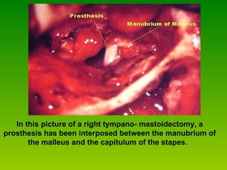 In this picture of a right tympano- mastoidectomy, a prosthesis has been interposed between the manubrium of the malleus and the capitulum of the stapes.   