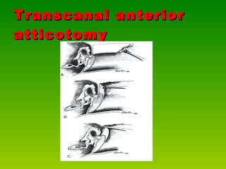 Transcanal anterior atticotomy 