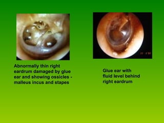                                 Glue ear with fluid level behind right eardrum                            Abnormally thin right eardrum damaged by glue ear and showing ossicles - malleus incus and stapes  