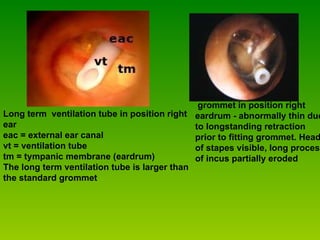                                     grommet in position right eardrum - abnormally thin due to longstanding retraction prior to fitting grommet. Head of stapes visible, long process of incus partially eroded                                    Long term  ventilation tube in position right ear eac = external ear canal vt = ventilation tube tm = tympanic membrane (eardrum) The long term ventilation tube is larger than the standard grommet   