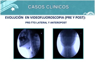EVOLUCIÓN EN VIDEOFLUOROSCOPIA (PRE Y POST):
PRE-TTO LATERAL Y ANTEROPOST
 