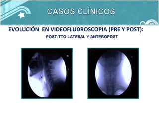 EVOLUCIÓN EN VIDEOFLUOROSCOPIA (PRE Y POST):
POST-TTO LATERAL Y ANTEROPOST
 