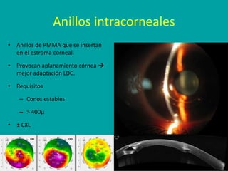 Anillos intracorneales
• Anillos de PMMA que se insertan
en el estroma corneal.
• Provocan aplanamiento córnea 
mejor ada...