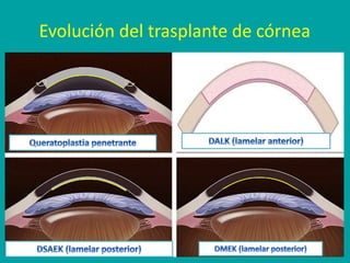 DMEK
PK
DSEK
DLEK
Dapena et al. Curr Opin Ophthalmol, 2009
Evolución del trasplante de córnea
 