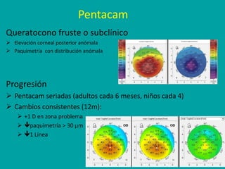 Pentacam
Queratocono fruste o subclínico
 Elevación corneal posterior anómala
 Paquimetría con distribución anómala
Prog...