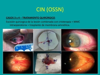 CIN (OSSN)
CASOS 3 y 4 – TRATAMIENTO QUIRÚRGICO.
Escisión quirúrgica de la lesión combinada con crioterapia + MMC
intraoperatoria + trasplante de membrana amniótica.
 