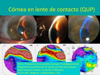 Córnea en lente de contacto (QUP)
Enf AI  depósito IC en perifería corneal  adelgazamiento
Progresión circunferencial  córnea en lente de contacto
Suele coexistir limbitis / escleritis (≠ Mooren)
Enf AI: AR > Wegener > Policondritis > LES
 