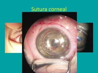 Sutura corneal
 