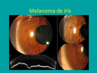 Melanoma de iris
 